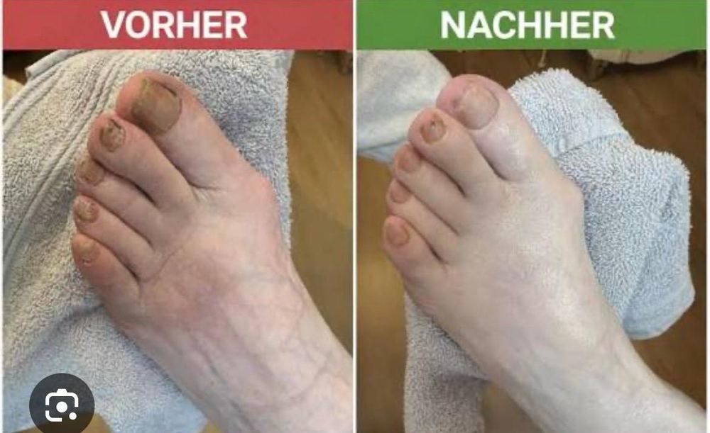 Fußpflege Vorher-Nachher 3